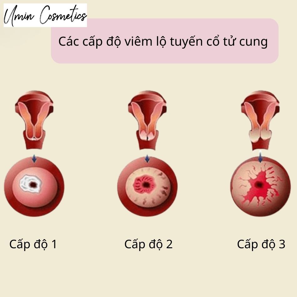 3 cấp độ viêm lộ tuyến cổ tử cung