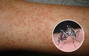 sốt do virut dengue